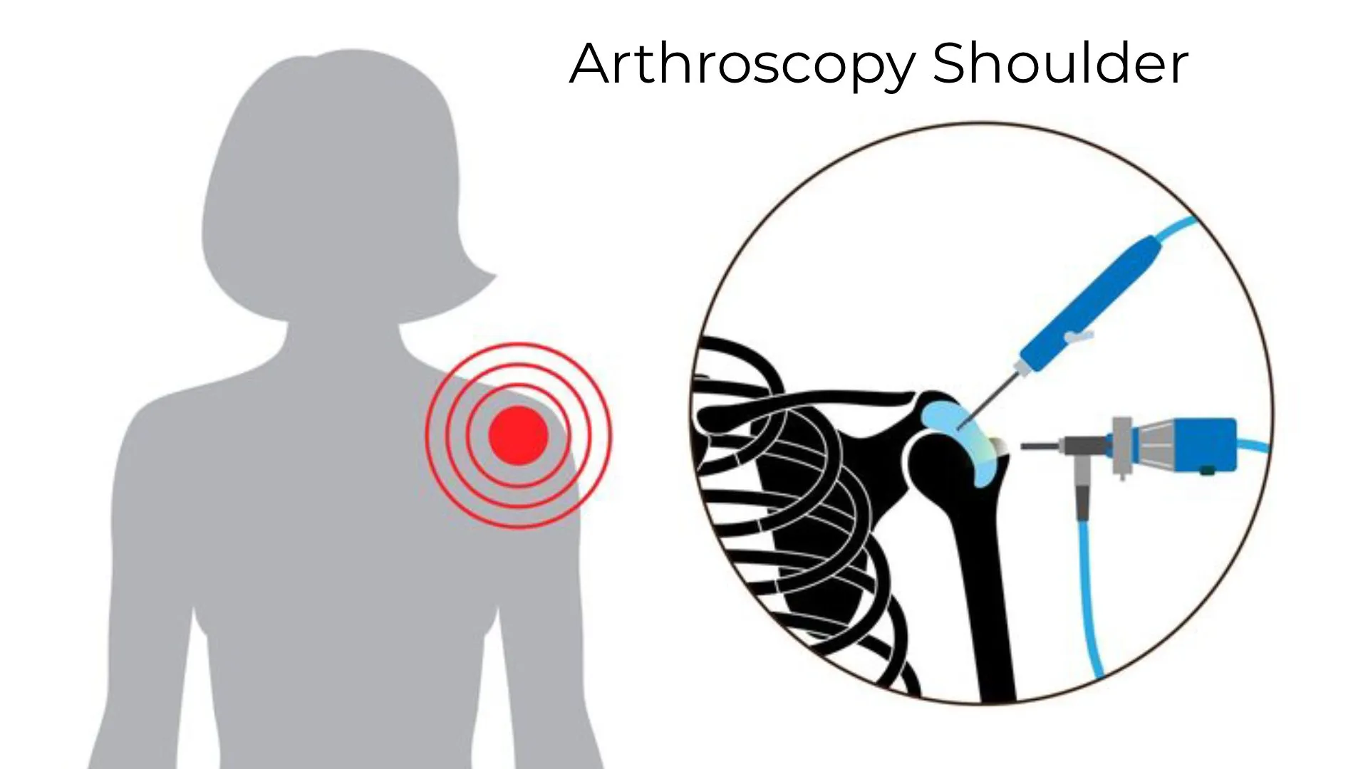 Arthroscopy Shoulder: Everything You Need to Know Before Your Surgery