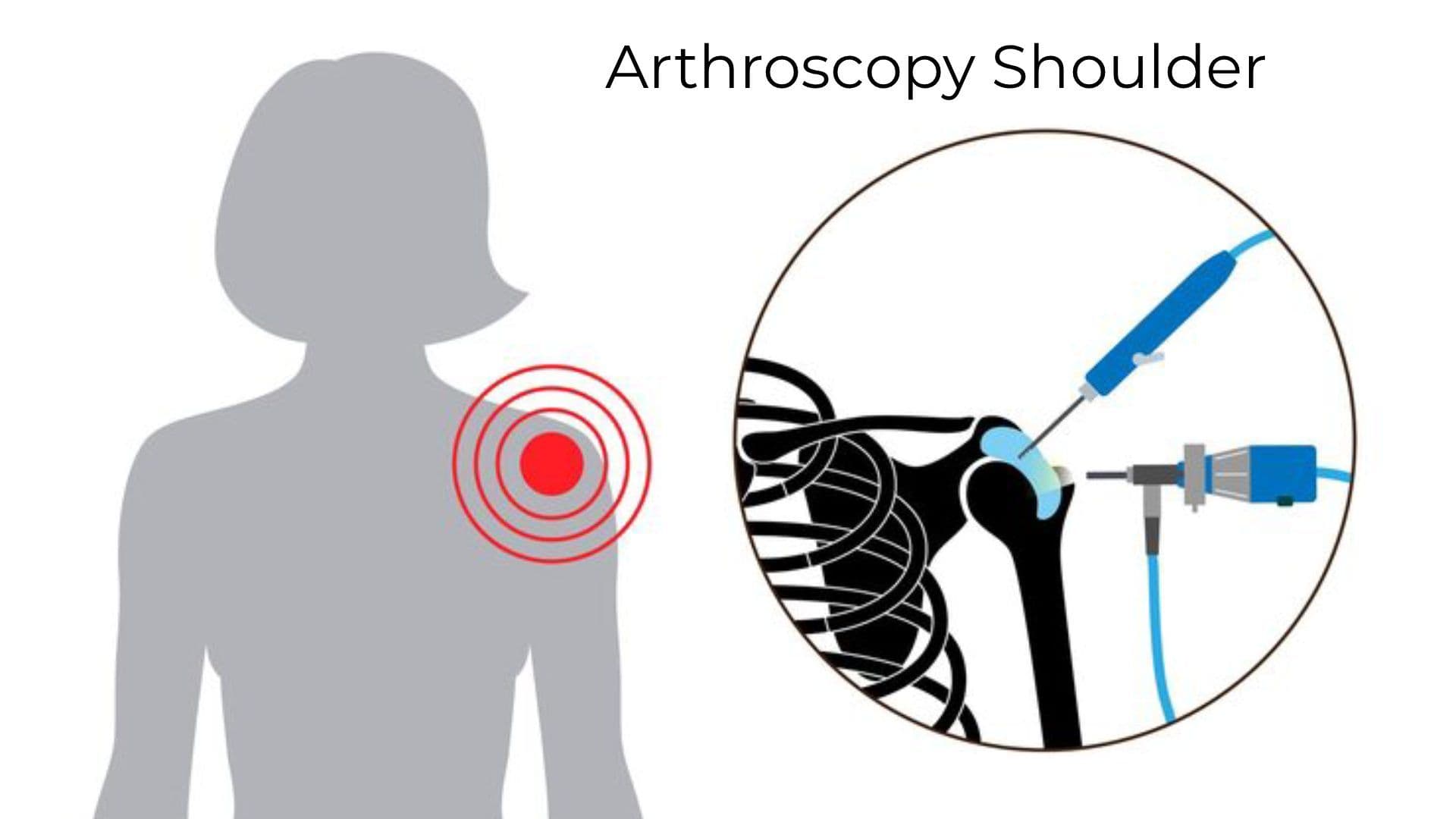 Arthroscopy Shoulder: Everything You Need to Know Before Your Surgery
